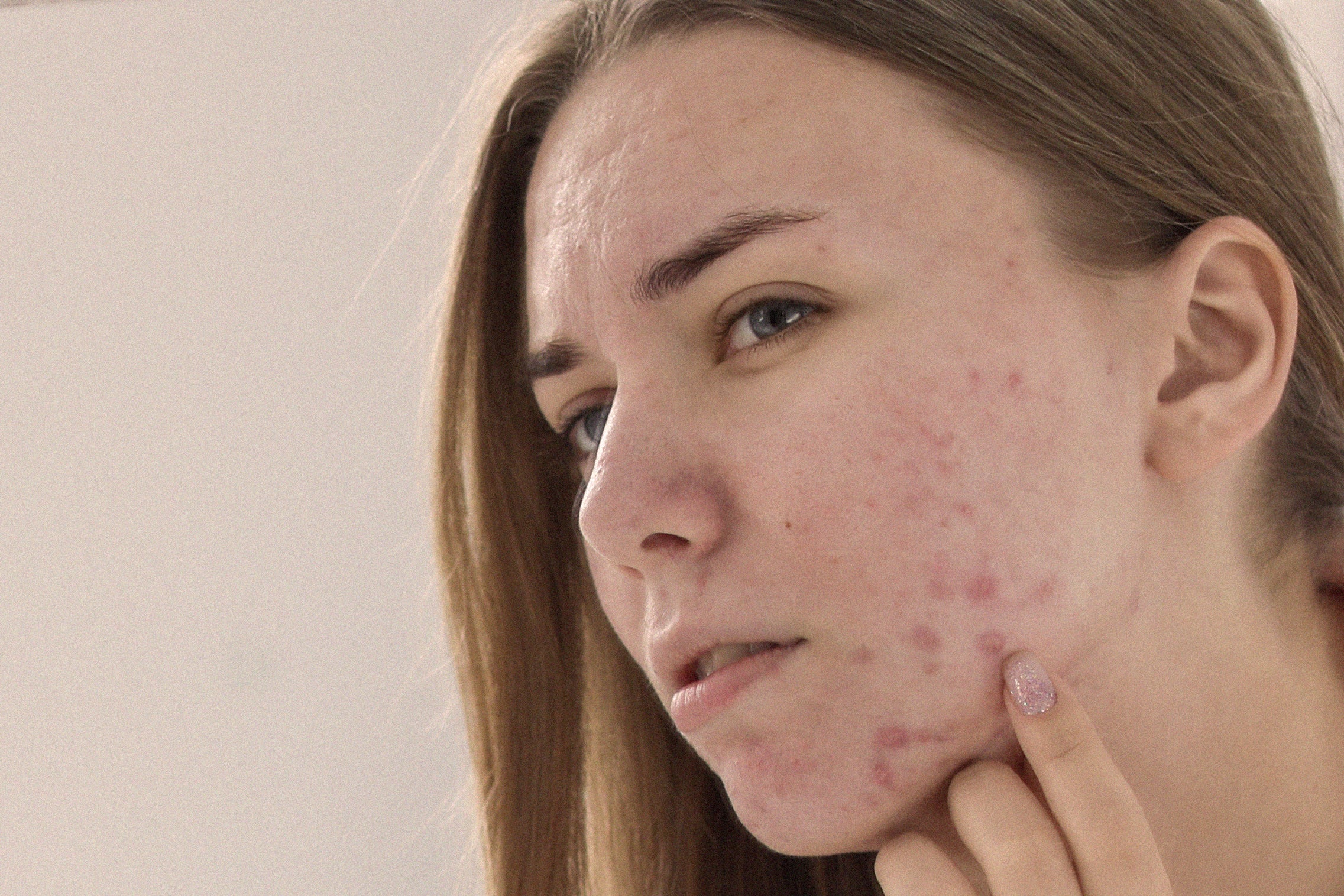 How To Fix Your Biggest ACNE Spot Treatment Issues