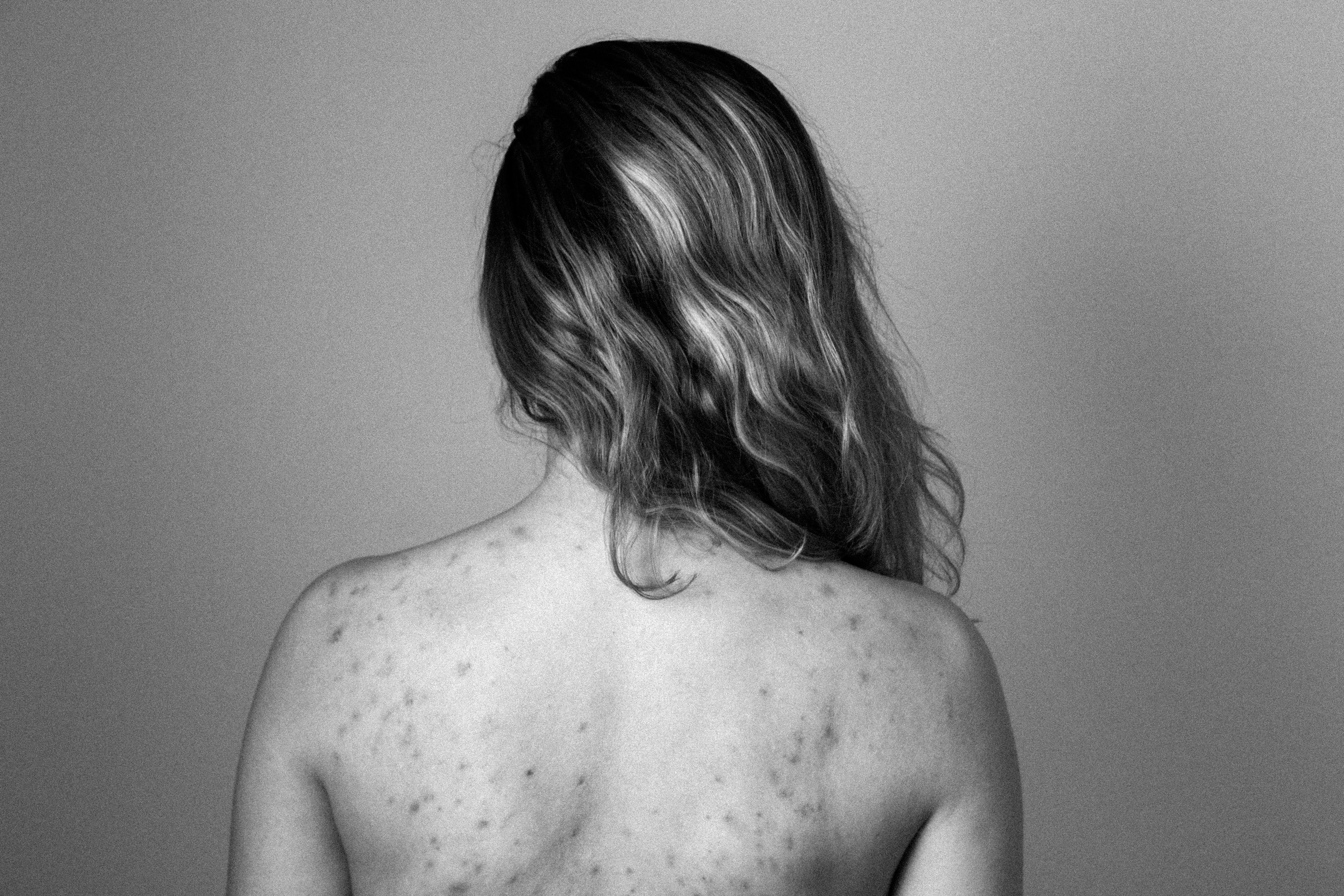Why Keratosis Pilaris is HELL in winter - and how to fix it!