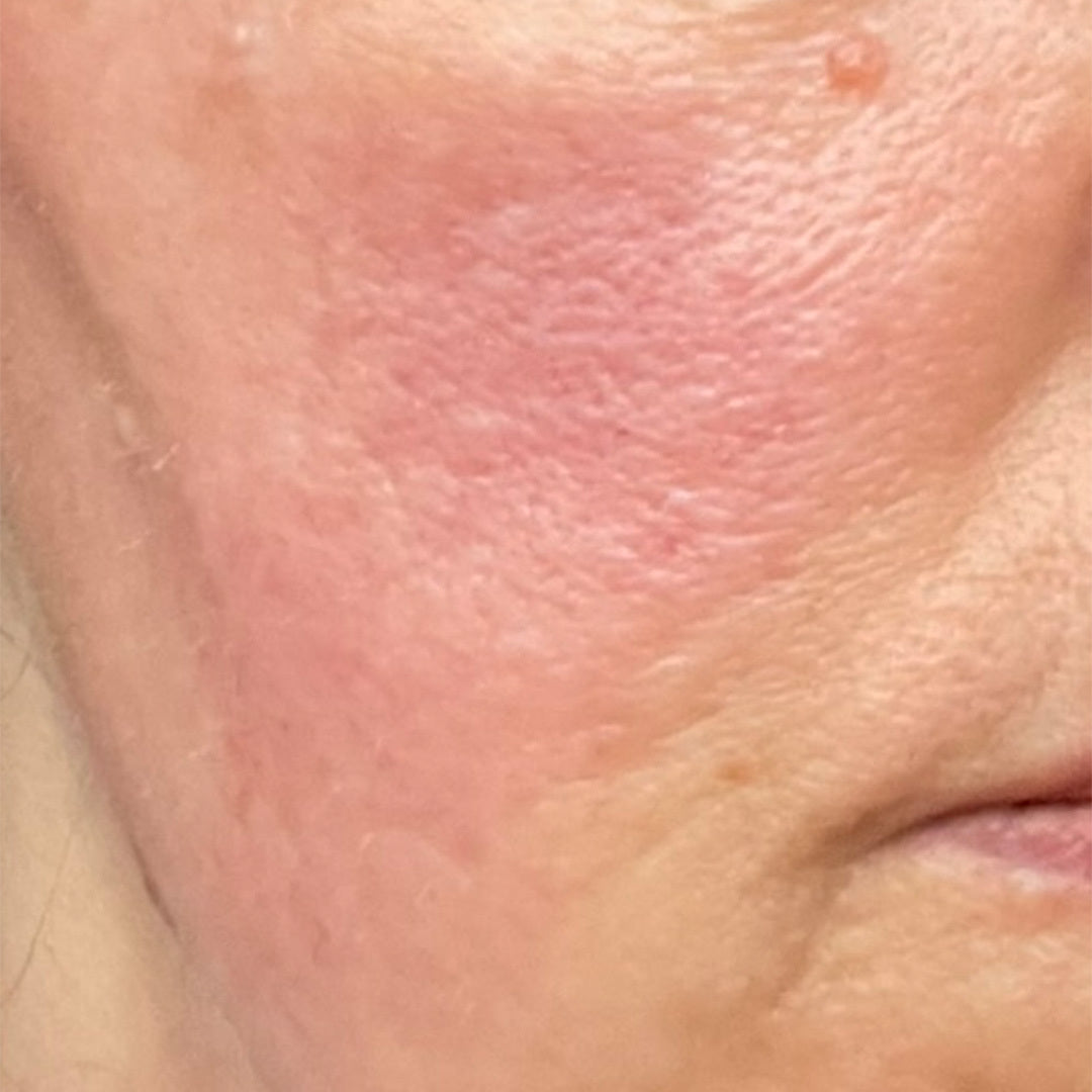 Before image of Skin Concern: Redness - Month 12
