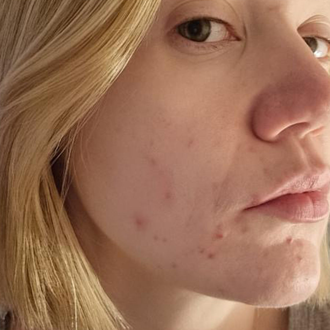 Before image of Skin Concern: Blemishes - Month 1