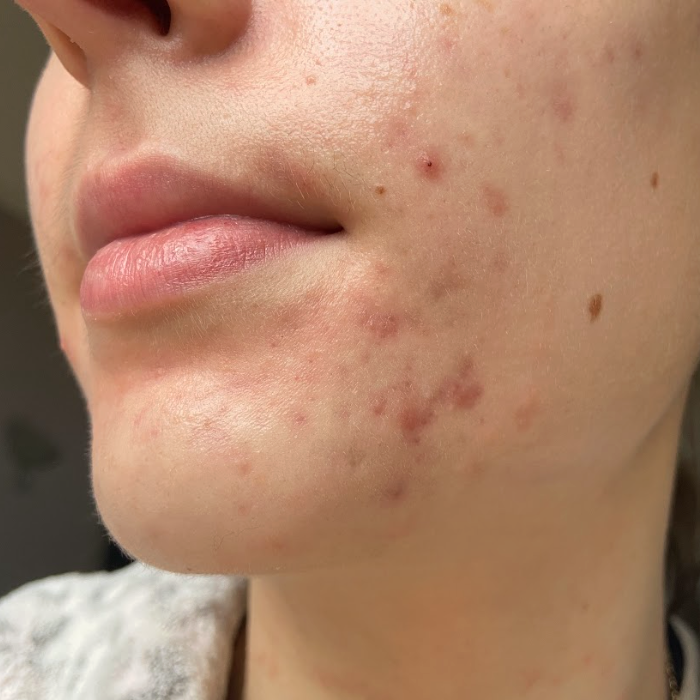 Before image of Skin concern: Blemishes - Month 3